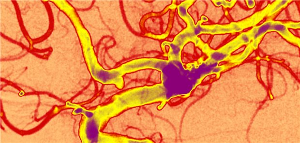 Hirnarterienaneurysma: bisher vor allem ein Zufallsbefund.