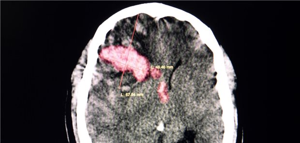 Hirnblutung im CT: Stürze zählen bei Senioren und Seniorinnen zu den häufigsten traumatischen Ursachen einer intrakraniellen Blutung.