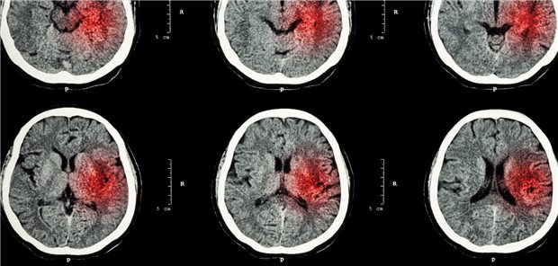 Hirnblutungen: Je länger eine Statintherapie dauert, umso geringer ist einer dänischen Studie zufolge das Risiko für intrakranielle Hämorrhagien.