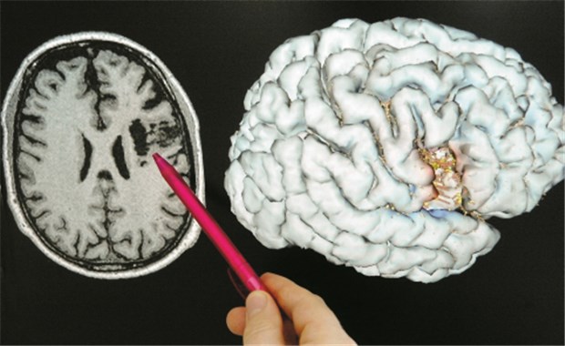 Schlaganfall-Prophylaxe bei Vorhofflimmern: Ansturm von neuen Antikoagulanzien Hirninfarktareal im MRT-Bild und 3-D-Rekonstruktion des Gehirns eines Patienten mit Schlaganfall. © dpa