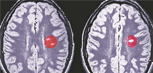 Hirnläsionen eines MS-Patienten im MRT-Bild: Neue Arzneien ermöglichen individuelle Therapien.