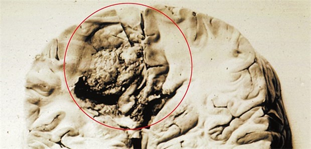 Hirnpräparat mit Glioblastom.