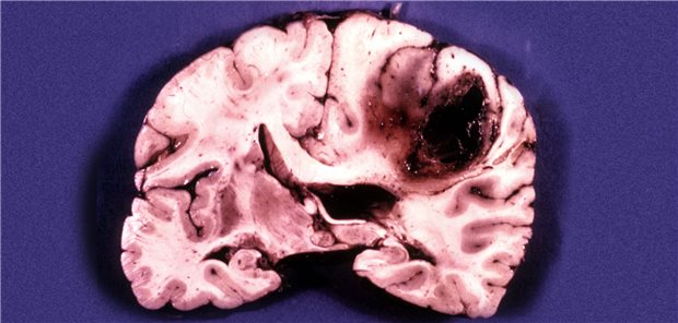 Hirnpräparat mit Glioblastom. Forscher haben jetzt geklärt, was sich bei Betroffenen im Gehirn abspielt.
