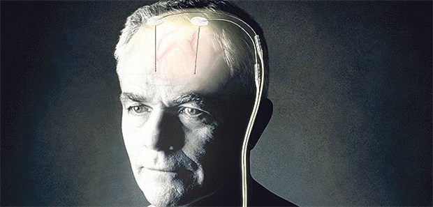 Hirnstimulation rückt den schiefen Hals wieder gerade Hirnschrittmacher können eine zervikale Dystonie lindern. Getestet wurden eine Frequenz von 180 Hz und eine Pulsdauer von 120 Mikrosekunden.