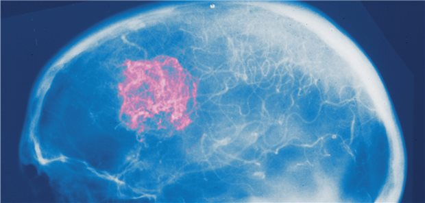 Hirntumor: Bei 50 bis 60 Prozent der Patientinnen und Patienten, bei denen einzelne Hirnmetastasen operativ entfernt wurden, entwickelt sich innerhalb von sechs bis zwölf Monaten nach Resektion ein lokales Rezidiv.