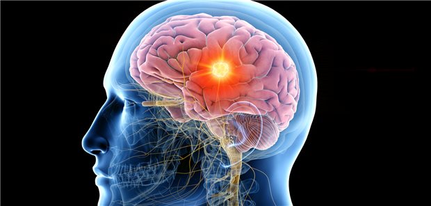 Hirntumor: Von einer Zusatztherapie mit Interferon profitierten vor allem Personen mit Grad-3-Gliomen und solche mit nichtmethyliertem MGMT-Promotor.