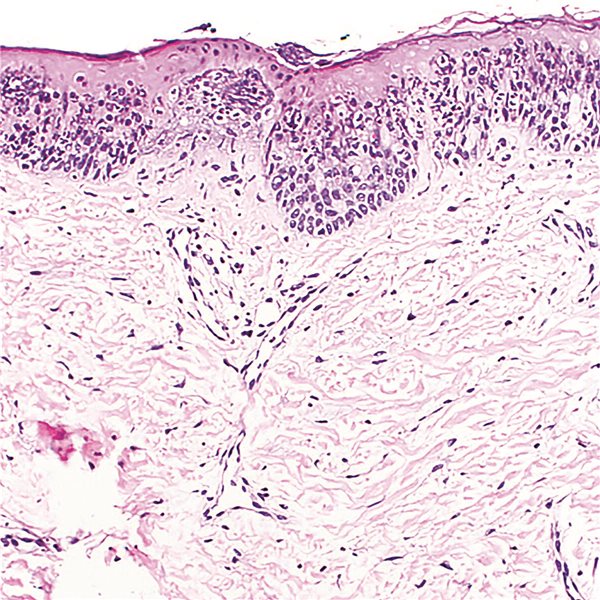 Pellagra statt Akne – Frau lebte 20 Jahre mit falscher Diagnose Histologie-Bild