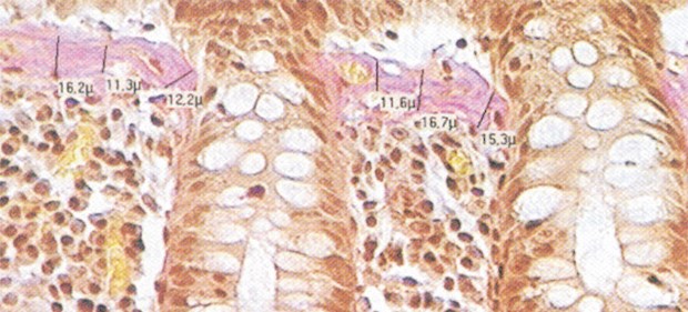 Histologie der Kolonschleimhaut bei kollagener Kolitis: Das subepitheliale Kollagenband (rosa) ist verdickt.