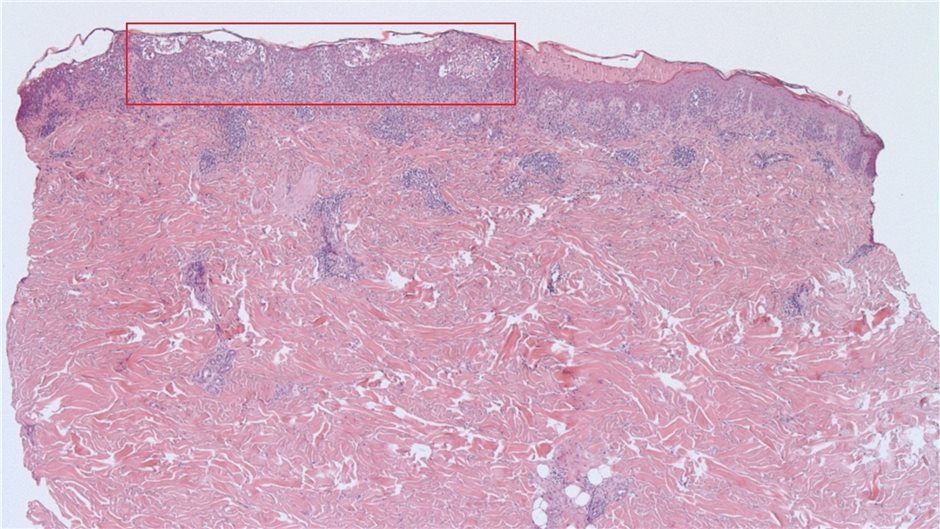 Histologie: spongiotische Auflockerung des Epithels mit zahlreichen Neutrophilen...