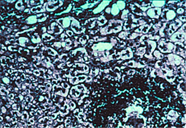 Sind die kleinen Gallenwege entzündet, muss die Therapie schnell beginnen Histologischer Schnitt bei primär biliärer Zirrhose.