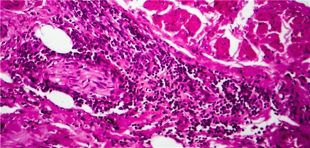 Histologischer Schnitt eines Harnblasenkarzinoms. Die Ergebnisse von Langzeitstudien werden noch eine Weile auf sich warten lassen.
