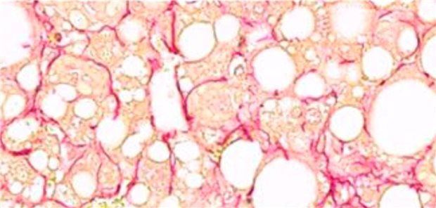 Wie bei Fettleber die gefährliche Steatohepatitis entstehen kann Histologischer Schnitt von Lebergewebe mit Fibrose und rot markierten Kollagenfasern.