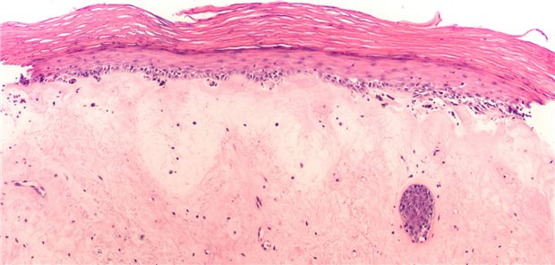 Lichen sclerosus erkennen und leitliniengerecht therapieren Mikroskopische Aufnahme einer Gewebeprobe mit Lichen sclerosus einer Hauterkrankung unbekannter Ursache, die typischerweise an den Genitalien (Vulva oder Penis) auftritt.