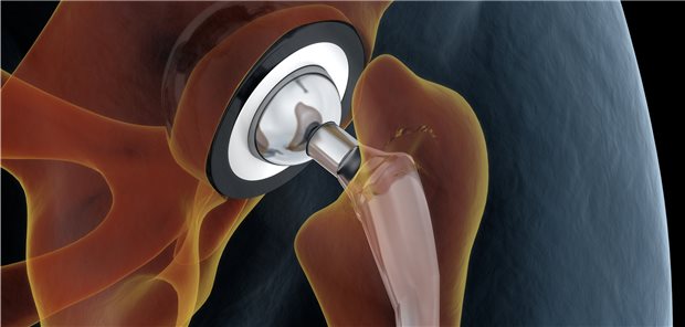 Hüft-TEP: Damit läuft es wohl nicht nur bei der Bewegung wieder runder, sondern auch kognitiv.