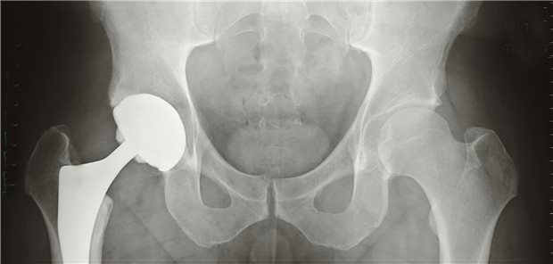 Hüft- und Knietotalendoprothesen fallen seltener aus, wenn Klinik häufig implantiert Hüftendoprothese: Erfahrung der implantierenden Klinik zahlt sich aus.