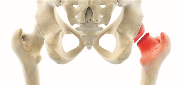 Hüftfraktur: Median lebten operierten Patienten noch 1,4 Jahre, Patienten der Vergleichsgruppe mit palliativer Versorgung noch 0,4 Jahre.