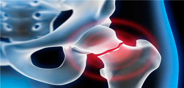 Hüftfraktur: Trotz des stark erhöhten Risikos für Folgefrakturen wird in Deutschland immer noch nur bei maximal der Hälfte der osteoporotischen Frakturen eine Therapie eingeleitet.