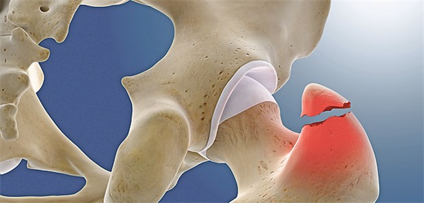 Hüftfraktur nach einem Sturz: Welchen Einfluss haben Antihypertensiva auf das Frakturrisiko?