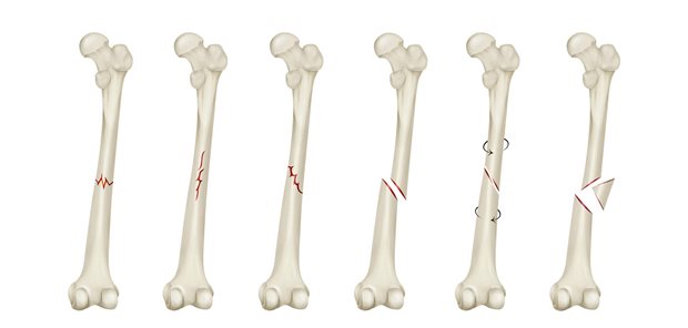 Hüftfrakturen im Fokus: In einer aktuellen Studie zeigte sich, dass das Risiko einer atypischen Femurfraktur mit der Einnahmedauer von Bisphosphonaten (BP) zwar stieg, das Hüftfrakturrisiko war bei längerer BP-Einnahme jedoch rückläufig.