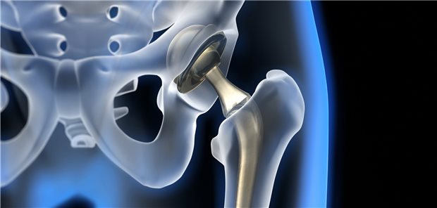 Hüftgelenkarthrose: Kortikoidinjektionen ins Gelenk scheinen neuen Studiendaten zufolge den Gelenkersatz eher zu beschleunigen statt ihn hinauszuzögern.