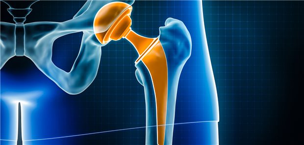 Hüftgelenkersatz: Metformin könnte möglicherweise bei Arthrose den Bedarf an Gelenkersatz reduzieren. Aus einer Studie mit Diabetes-Patienten gibt es Hinweise darauf.
