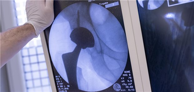 Hüftgelenksprothese im Röntgenbild: Beim geplanten Einsatz, Wechsel oder der Entfernung von Total- und Teilprothesen der Hüftgelenke sollen Zweitmeinungsverfahren wohl ab Juli 2024 möglich werden. Das hat der G-BA beschlossen.