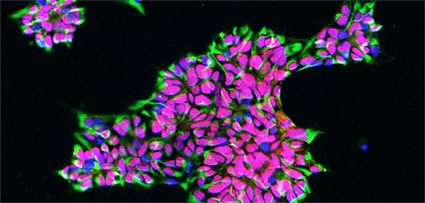 Mit Stammzellen MS-Defekte reparieren Humane induzierte neurale Stammzellen können aus Hautzellen hergestellt und unbegrenzt in der Petrischale gezüchtet werden.