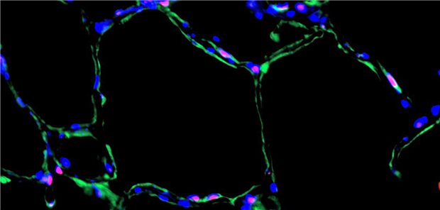 Humaner Präzisionslungenschnitt mit künstlich induzierter Seneszenz (rot), epithelialen Differenzierungszwischenstufen (grün) und Zellkernen (blau).
