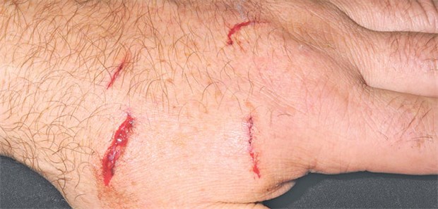 Infektion oft bei stichartiger Wunde Hundebiss in der Hand eines 55-jährigen Mannes. Infektionen sind eine häufige Komplikation.