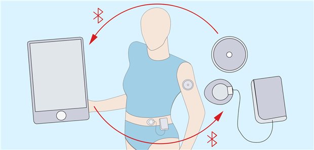 Hybrider Closed Loop: Die Insulin-Basalrate wird meist automatisch abgegeben, bei Mahlzeiten muss der Nutzende nachsteuern. Elektronische Entscheidungshelfer bieten Orientierung dabei.

