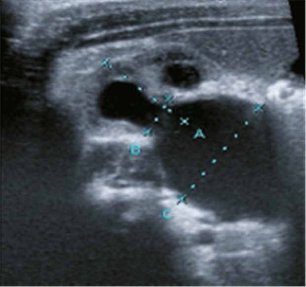 Erste Harnwegsinfektion immer abklären! Hydronephrose bei einem männlichen Säugling mit schmalem, echoreichem, kaum durchblutetem Parenchymsaum. © Jürgen Dippell (2)