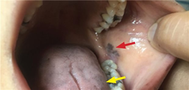 Hyperpigmentierte Veränderungen des Gewebes an der bukkalen Mukosa (roter Pfeil), Zunge (gelber Pfeil) und an der Unterlippe (schwarzer Pfeil). (Reprinted with permission from Zhou J, Reddy SSK. Oral hyperpigmentation with weakness and salt-craving. Cleve Clin J Med 2022; 89(4):180–181. doi: 10.3949/ccjm.89a.21036.)
