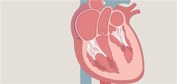 Abbild eines Herzens mit Hypertropher Kardiomyopathie.