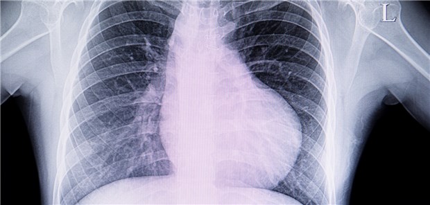 Forscher aus Hannover entwickeln Fibrose-Therapie Hypertrophie: Bei Patienten mit Fibrose ist das Herz häufig vergrößert.