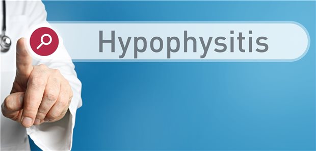 Hypophysitis – sie kann Nebenwirkung einer Therapie mit CPIs sein: Typische klinische Warnsymptome und Laborkonstellationen sind Abgeschlagenheit, Hyponatriämie und Kopfschmerzen.