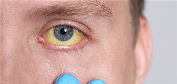 Ikterus: Ein typisches Symptom von Virushepatitis.
