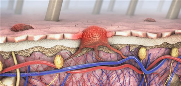 Illustration der Haut und eines Melanoms – hier eines, das Lymphtrakt und Blutkreislauf penetriert.