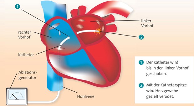 Die Befreiung von der Antikoagulation? Illustration der Katheterablation bei Vorhofflimmern.