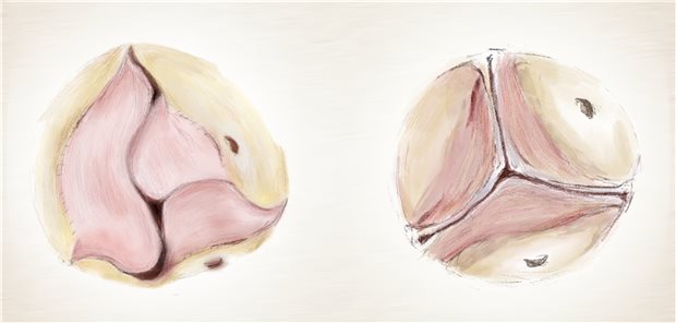 Aortenklappe aus eigenem Herzgewebe Illustration der Ozaki-Klappe in der Ansicht von oben (links) und zum Vergleich die normale Aortenklappe von oben (rechts).