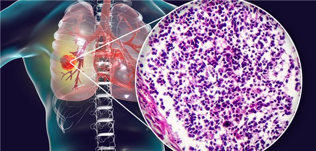 Illustration des Kleinzelligen Lungenkarzinoms (SCLC)