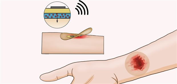 Illustration des intelligenten Verbands zur drahtlosen Übermittlung von Temperatur und Bioimpedanz-Werten.