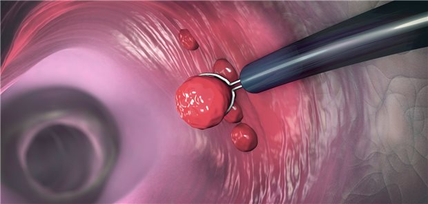 Illustration einer Polypektomie: Bei der Nachsorge nach  Entfernung eines Polypen gibt es noch Verbesserungsbedarf.