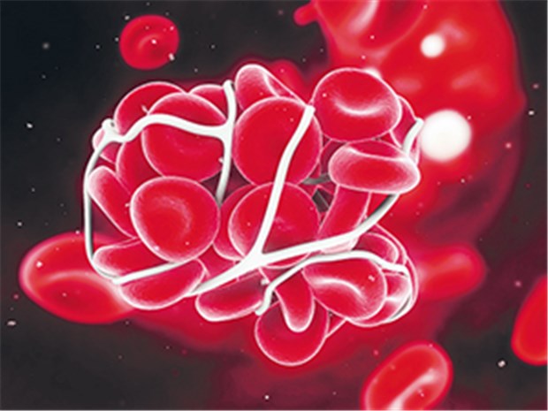 Thromboserisiko mit neuem Score abschätzbar Illustration eines Blutgerinnsels.