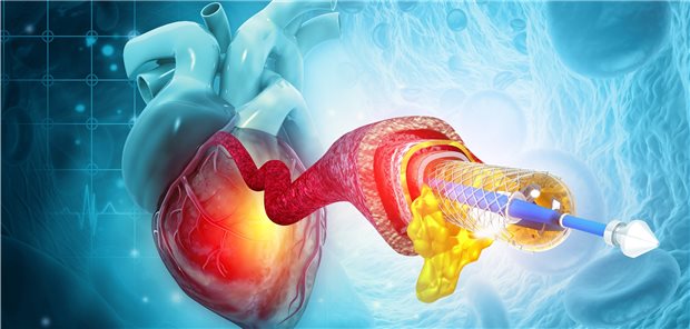 Illustration in 3D: Ein Stent wird mit Katheter in ein Koronargefäß eingesetzt.