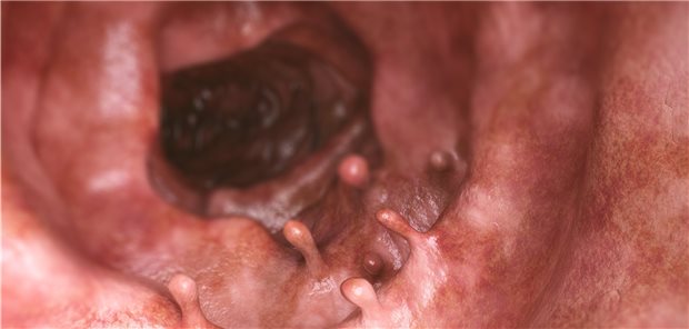 Illustration intestinaler Polypen.