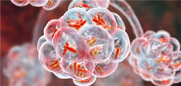 Illustration vom Auslöser der Legionärskrankheit, Bakterien der Gattung Legionella, in den Alveolen.