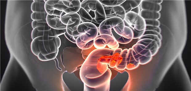 Illustration von Darmkrebs.