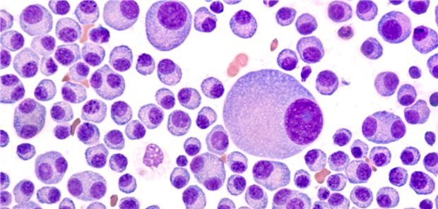 Im Blutausstrich eines Patienten mit multiplem Myelom sind die atypischen Plasmazellen gut zu erkennen.