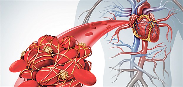 Im Fokus der Therapie: Blutgerinnsel in Koronargefäß.
