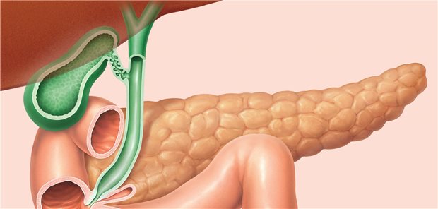 Im Fokus der Therapie mit Pemigatinib: die ableitenden Gallenwege.